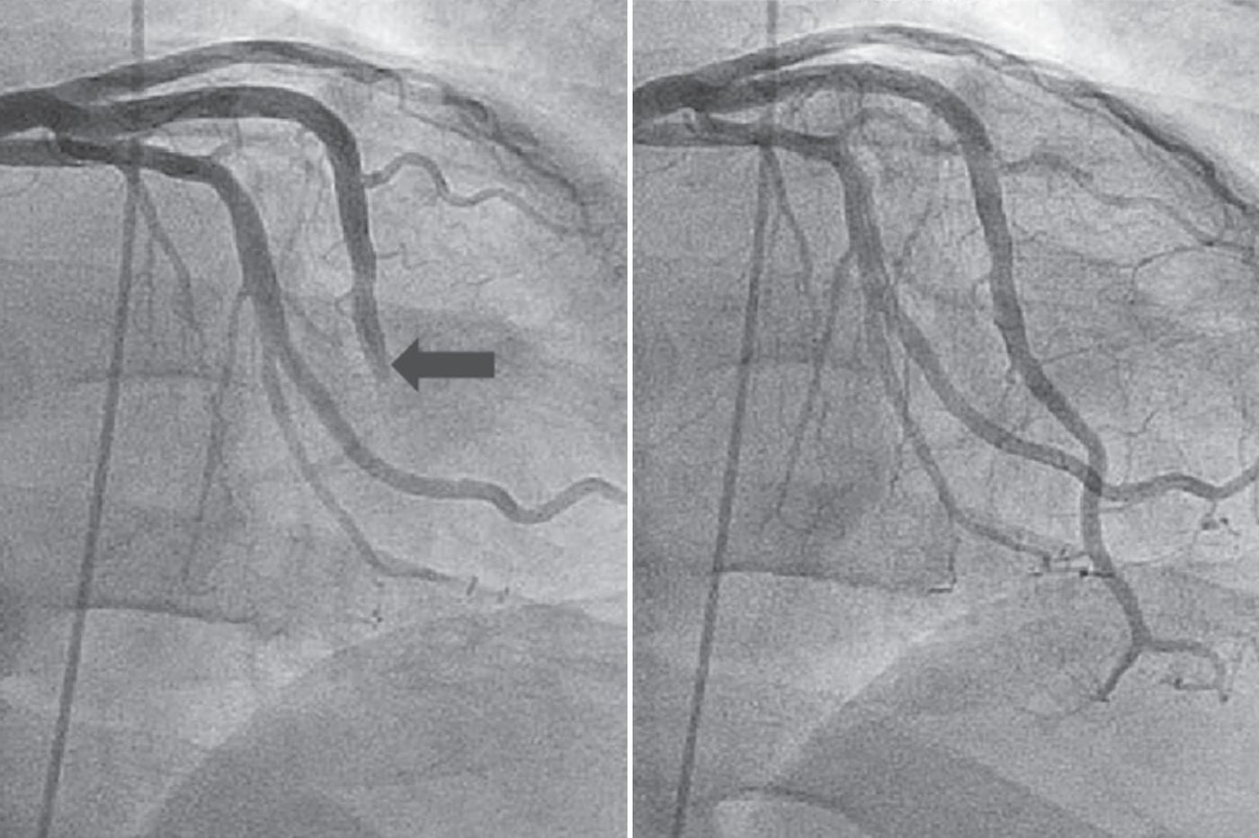 For Chest Pain Not Caused By A Heart Attack Jefferson Doctors Have A Remedy