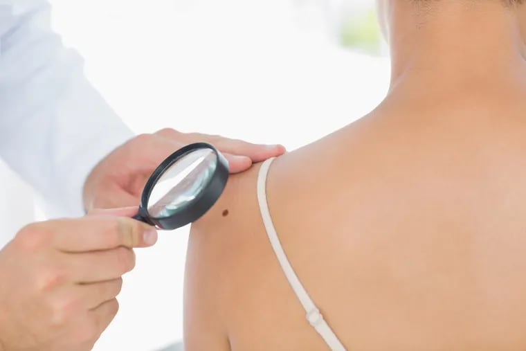 Moles are a common skin growth, and most are harmless. But changes in moles and other pigmented patches may be the sign of skin cancer, particularly melanoma. (Dreamstime/TNS)