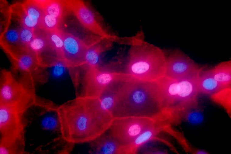 This undated fluorescence-colored microscope image made available by the National Institutes of Health shows a culture of human breast cancer cells. University of Pennsylvania is among the cancer institutions developing a vaccine for cancers caused by BRCA gene mutations.