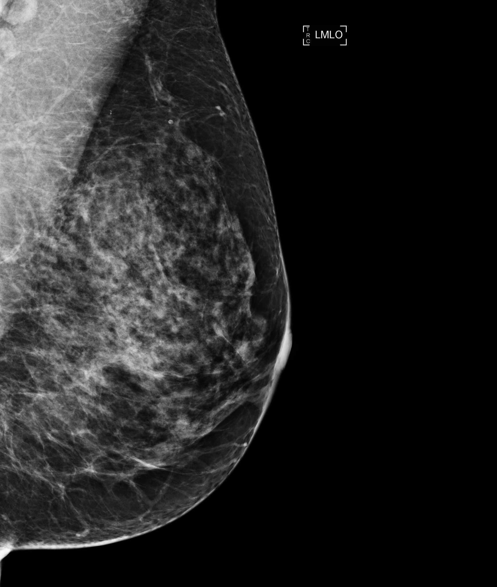 Dense breasts on a mammogram? What to know and do - Harvard Health