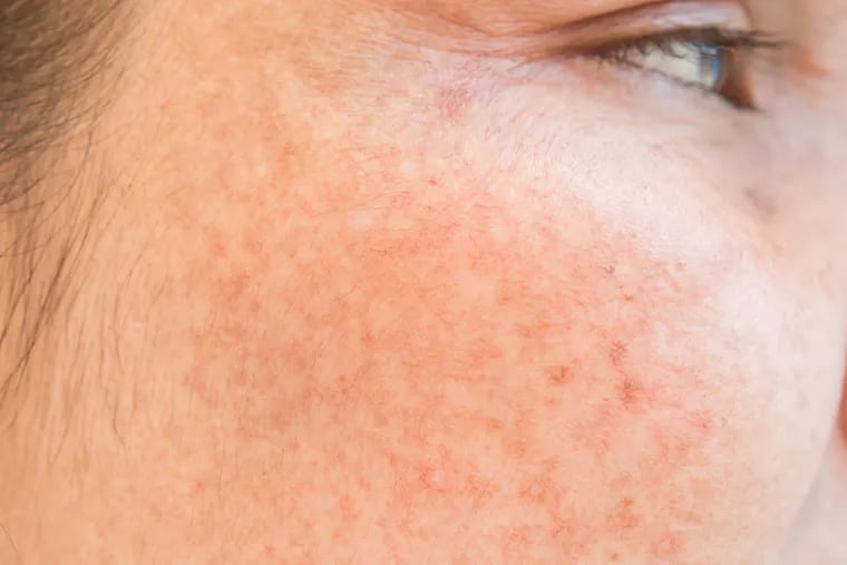 Q&A: What causes dark spots on skin and what works to fade them?