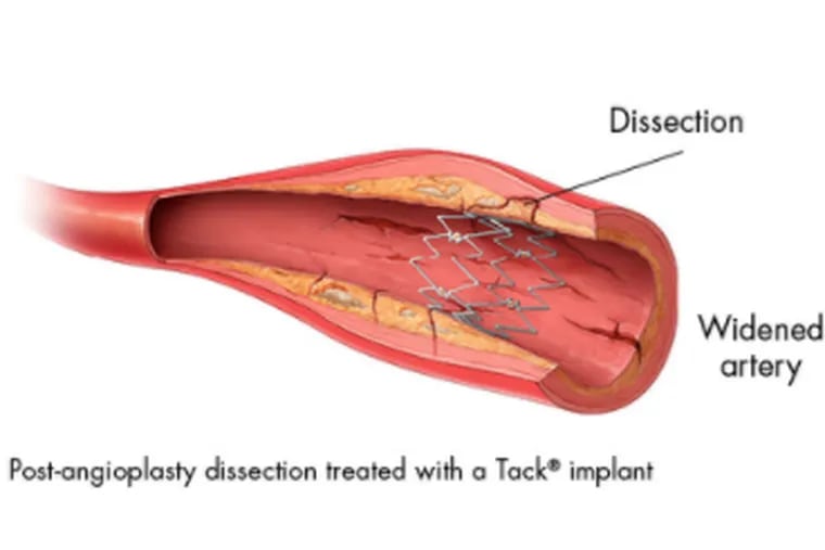 Intact Vascular's Tack Endovascular System, conceived by vascular surgeon Peter Schneider, and developed as a commercial product.