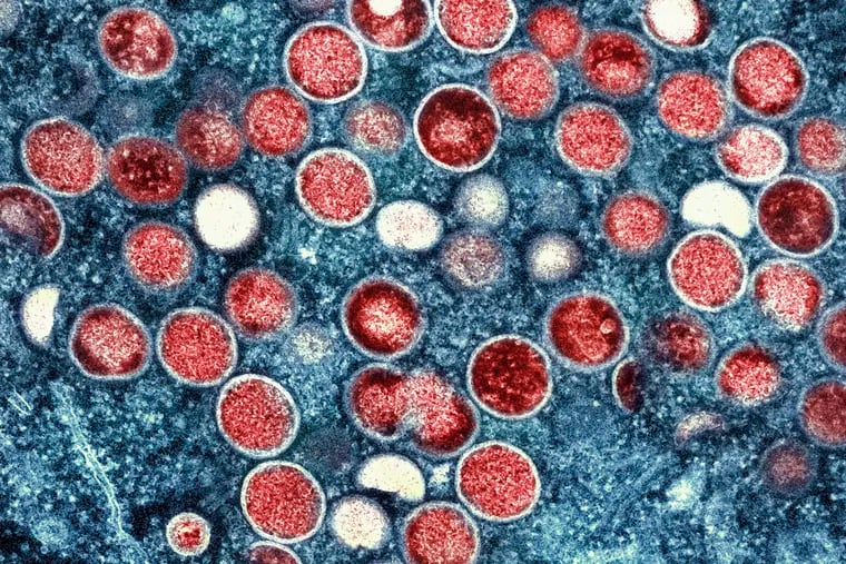 A color-enhanced image of monkeypox particles and infected cells.