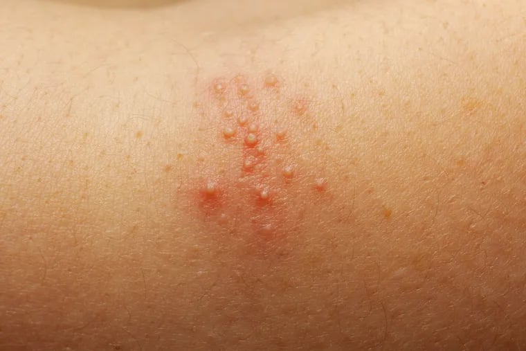 What Are Heat Hives? - The Dermatology Clinic
