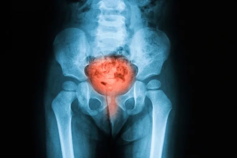 Urinary Tract Infections send millions of women - and men - to the hospital every year and can kill if infection spreads to the kidneys or blood. Nabriva, with U.S. operations based in King of Prussia, has a "new" drug to treat chronic UTIs called Contepo. (iStock.com/Sutthaburawonk)