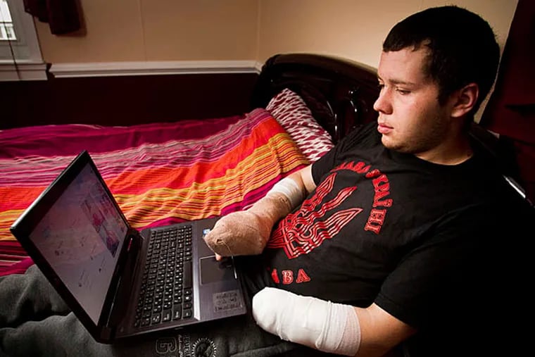 Roman Dzivinskyi, of Ukraine, lost his left hand after a package he was carrying exploded. He lost part of his index finger and thumb on his right hand. ( ALEJANDRO A. ALVAREZ / STAFF PHOTOGRAPHER )